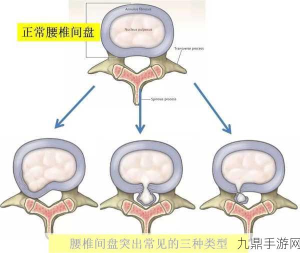 颈腰挺过那层薄膜好疼，1. 颈腰痛苦背后的隐秘薄膜